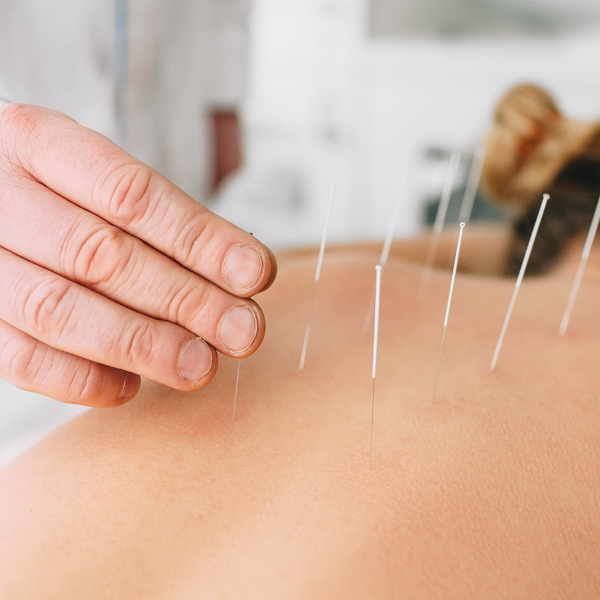 Hand placing acupuncture needles on a patient’s back during a therapy session at Iyali Chennai.